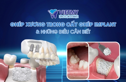 GHÉP XƯƠNG TRONG CẤY GHÉP IMPLANT- PHƯƠNG PHÁP BỔ XUNG HỖ TRỢ VÀ TÁI TẠO XƯƠNG HÀM